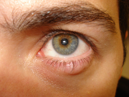 Stye and chalazion - Images | BMJ Best Practice