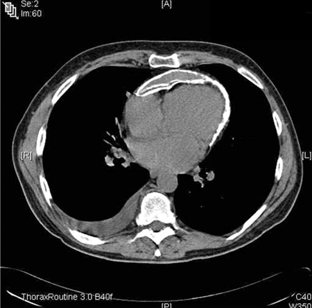 Pericarditis - Images | BMJ Best Practice