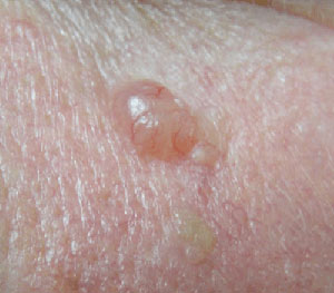 Overview of skin cancer - Summary of relevant conditions ...