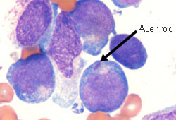 Acute myelogenous leukemia - Investigations | BMJ Best Practice