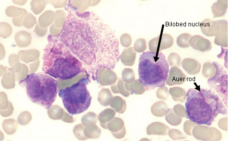 Acute myelogenous leukemia Investigations BMJ Best 