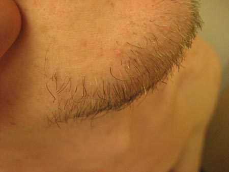 Folliculitis Approach Bmj Best Practice