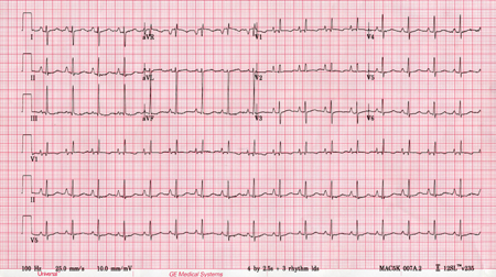 Htn pulmonar idiopático