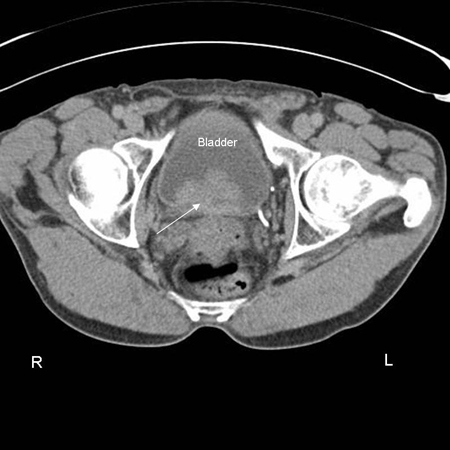 Evaluation of dysuria - Etiology | BMJ Best Practice