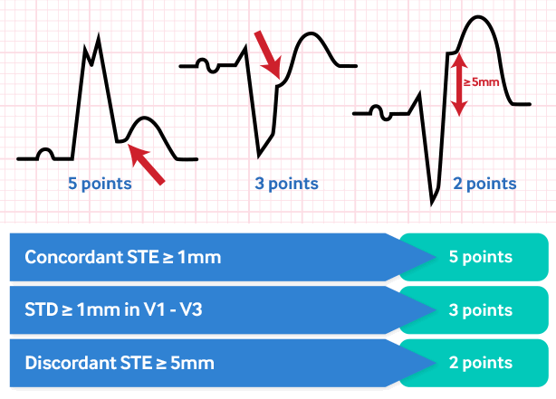 ST-elevation myocardial infarction - Investigations | BMJ Best Practice