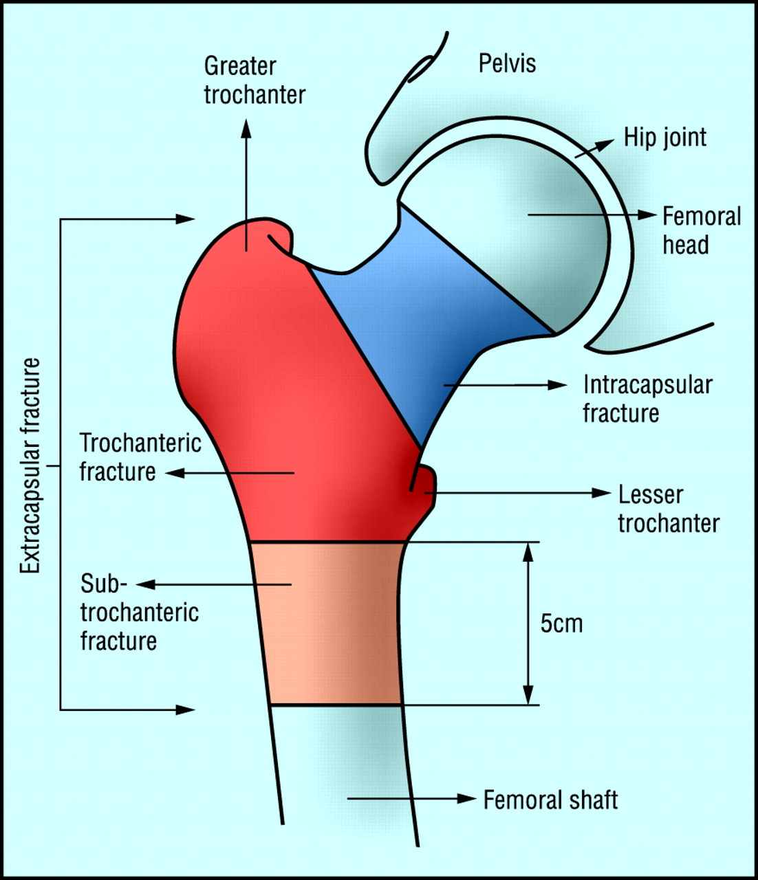 hip-fracture-images-bmj-best-practice