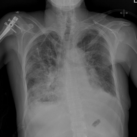 Acute heart failure - Diagnosis recommendations | BMJ Best Practice