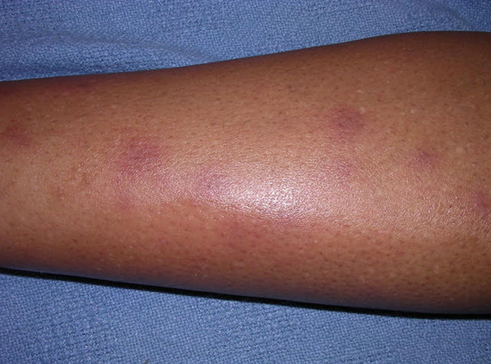 Erythema nodosum - History and exam | BMJ Best Practice