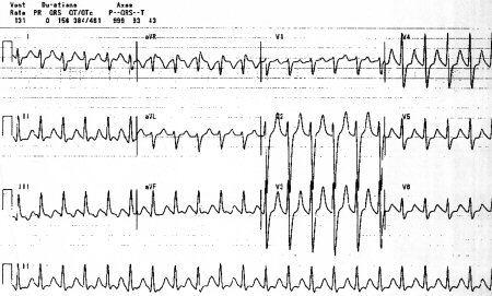 overdose tricyclic antidepressant bmj citation qrs presence preceding assess prolongation differentials ecg