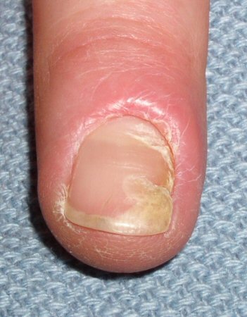 Paronychia - Symptoms, Diagnosis And Treatment | BMJ Best Practice