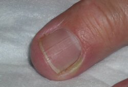 Paronychia Approach Bmj Best Practice