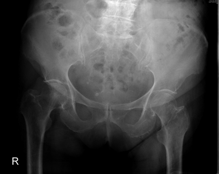 Hip fractures - Diagnosis Approach | BMJ Best Practice US