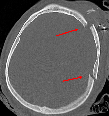 parkinsons disease oxford american neurology