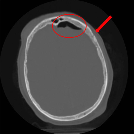 forehead skull fracture forehead skull fracture