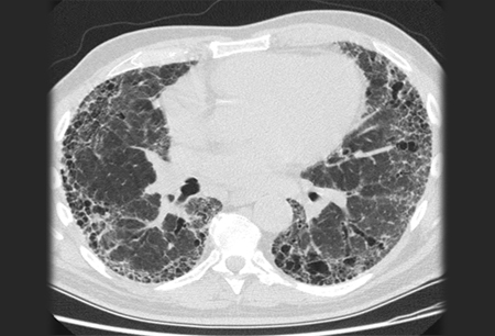 特发性肺纤维化 症状 诊断和治疗 Bmj Best Practice