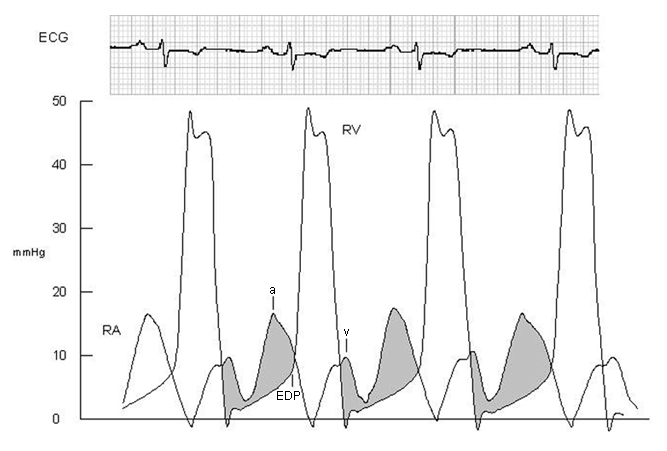 Tricuspid stenosis - Criteria | BMJ Best Practice