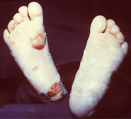 syphilis infection