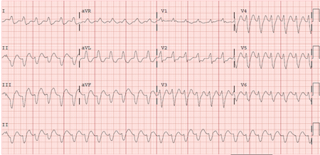 Sustained Ventricular Tachycardias Symptoms Diagnosis And Treatment Bmj Best Practice Us