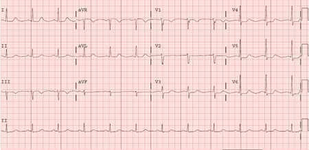 Morphological Criteria For Diagnosis Of Ventricular T - vrogue.co