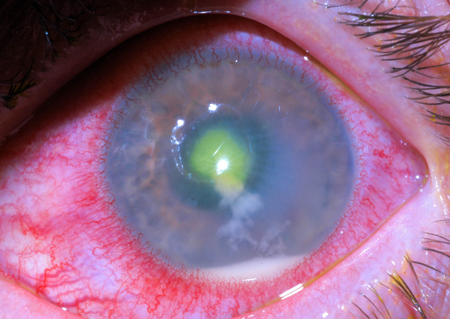 Corneal Infections