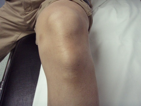 Osgood-Schlatter's disease - Case history | BMJ Best Practice