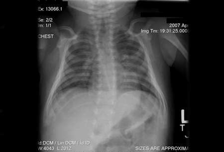 Severe combined immunodeficiency - Symptoms, diagnosis and treatment ...