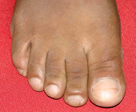 Evaluation Of Clubbing Differential Diagnosis Of Symptoms Bmj Best Practice Us Evaluation Of Clubbing Differential Diagnosis Of Symptoms Bmj Best Practice Us