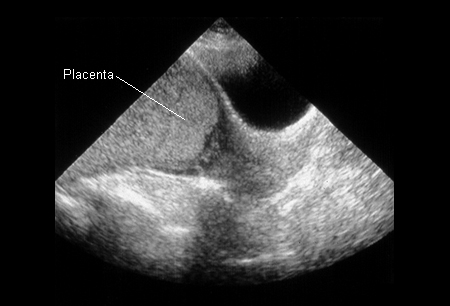 Placenta previa - Symptoms, diagnosis and treatment | BMJ Best Practice