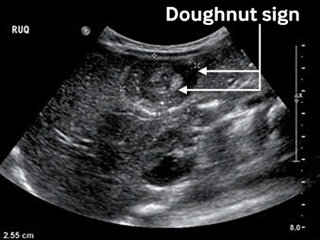 Intussusception Symptoms Diagnosis And Treatment Bmj Best