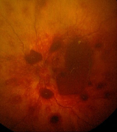 Abusive head trauma in infants images