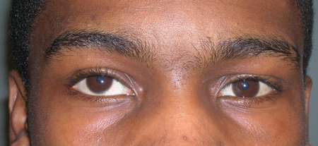 Strabismus - Images | BMJ Best Practice