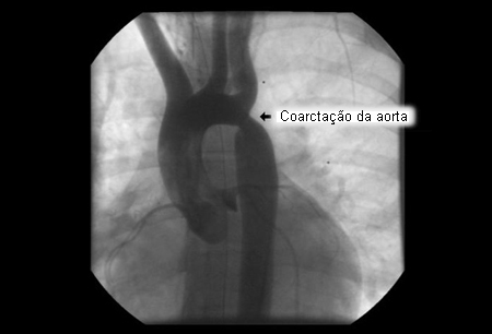 coarcta-o-a-rtica-symptoms-diagnosis-and-treatment-bmj-best-practice