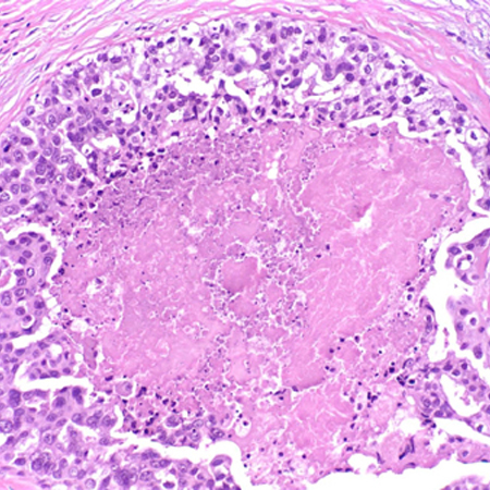 tratamento maternity carcinoma ductal popular situ