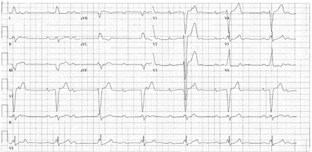 Atrioventricular block - Images | BMJ Best Practice