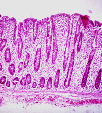 steatorrhea differential