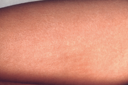 Assessment of maculopapular rash - Differential diagnosis of symptoms ...