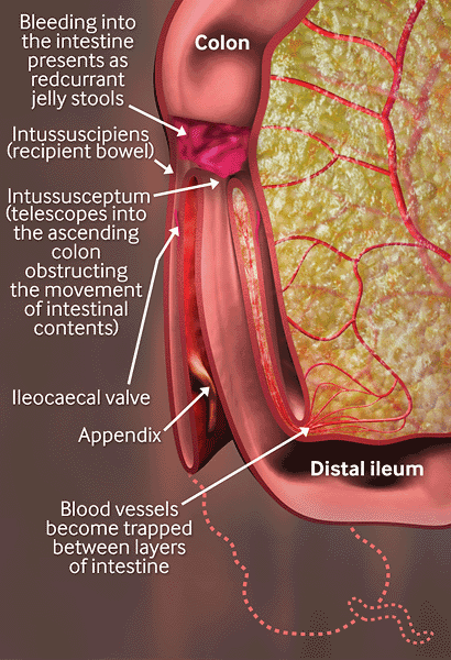 Evaluation Of Abdominal Pain In Children Etiology Bmj Best