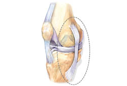 dor crônica no ligamento medial
