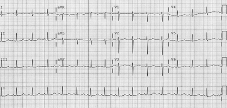 Long QT syndrome - Investigations | BMJ Best Practice