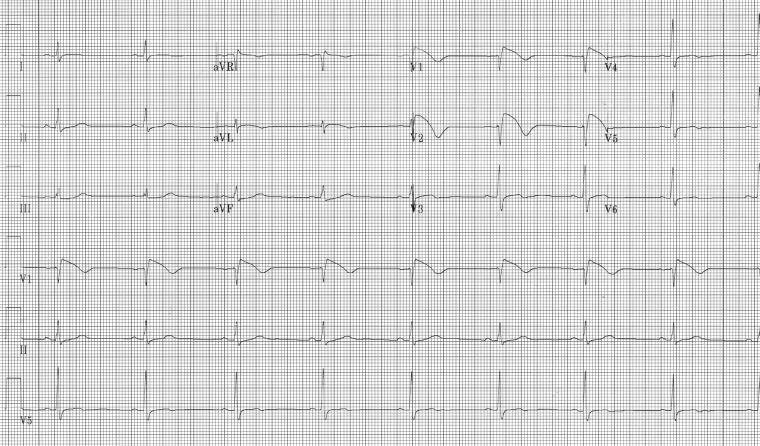 Non-sustained ventricular tachycardias - Images | BMJ Best Practice