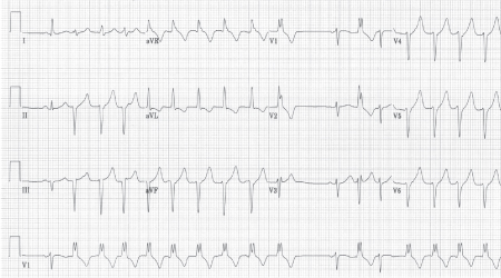 Nonsustained ventricular tachycardias - Approach | BMJ Best Practice