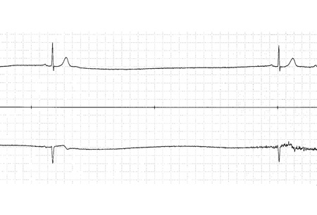 Bradycardia Symptoms Diagnosis And Treatment Bmj Best Practice