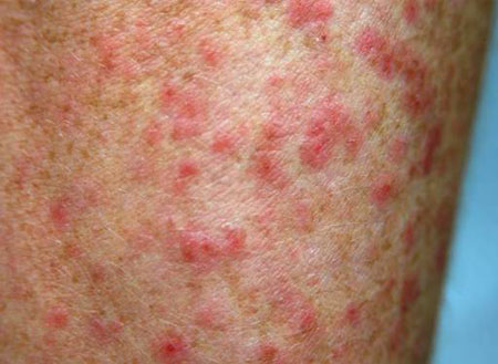 Bed Bug Rash