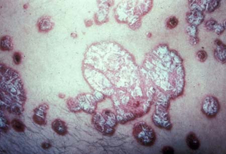 Assessment of dermatological disorders in HIV - Differential diagnosis ...