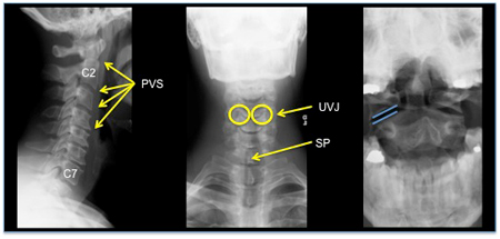 Acute cervical spine trauma - Investigations | BMJ Best Practice