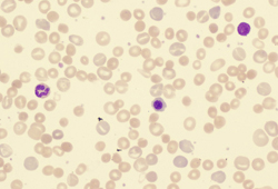 Hemolytic anemia - Images | BMJ Best Practice US