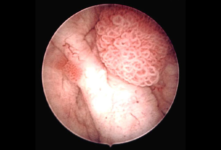 papillary lesion in bladder vierme bobbit