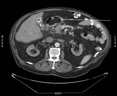 Lipoma - Images | BMJ Best Practice