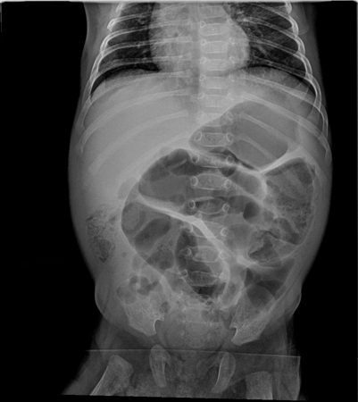 Small bowel obstruction - Approach | BMJ Best Practice